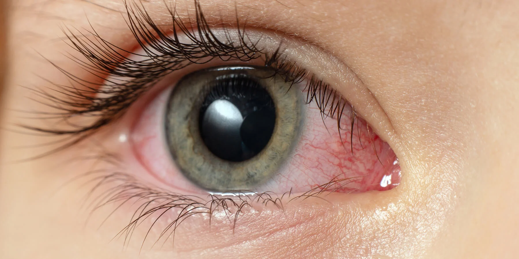 What is pink eye