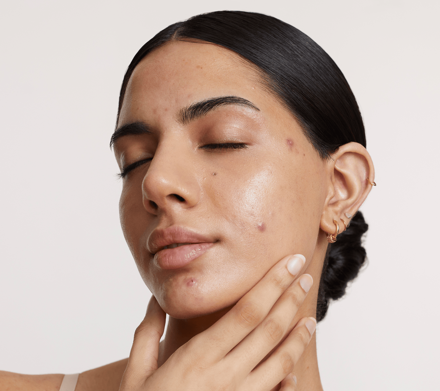 Nodular acne