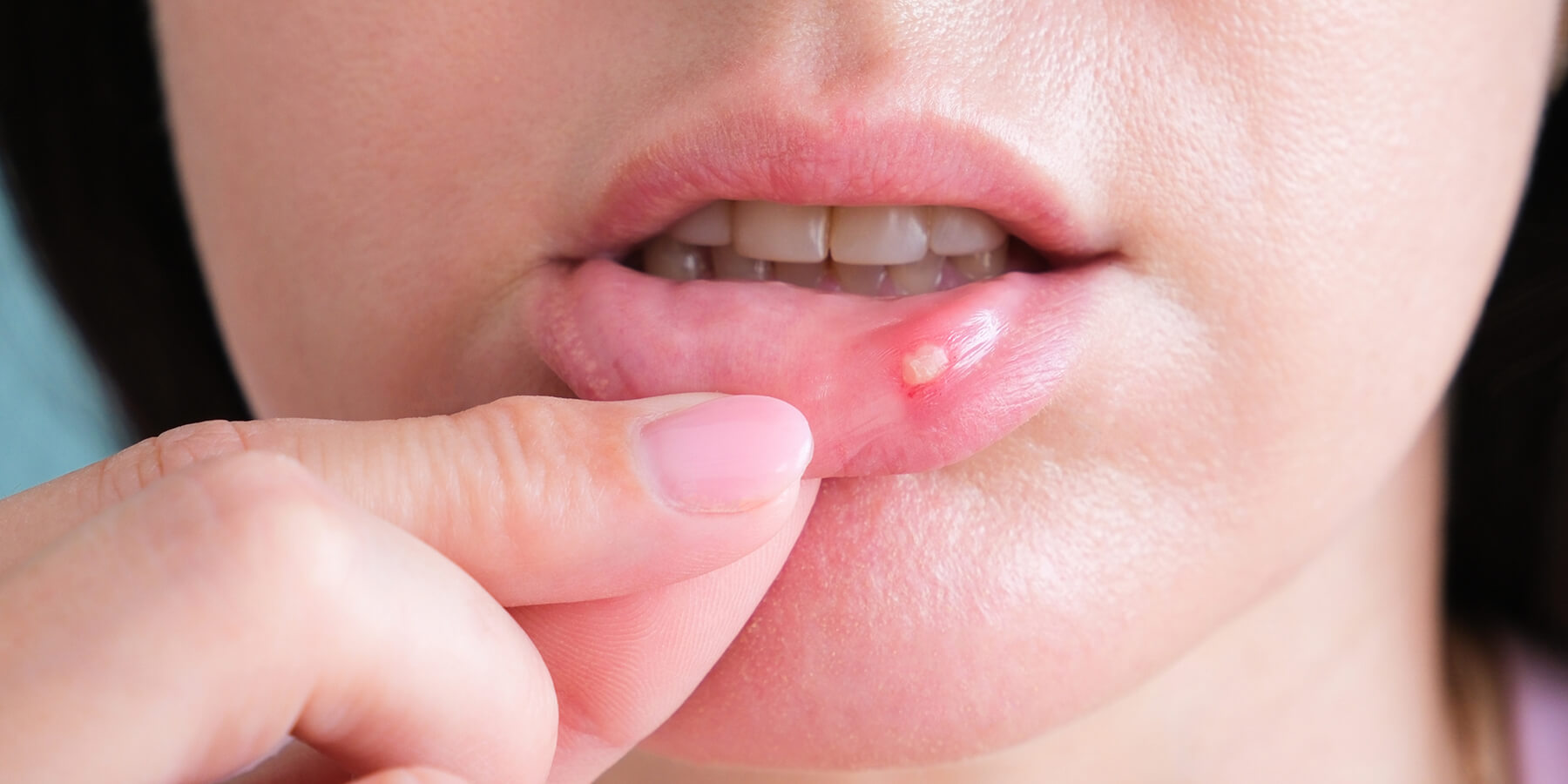What is a canker sore