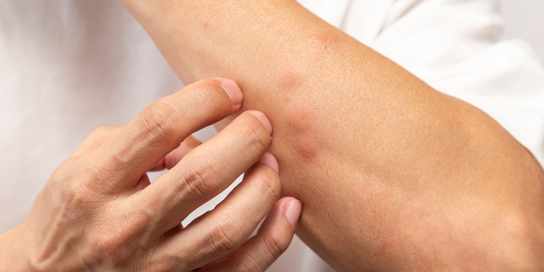 What are insect bites